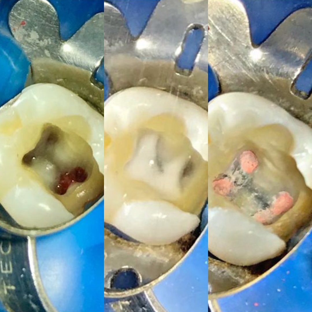 Rodrigues Odontologia Especializada Endodontia (Canal) #2.E