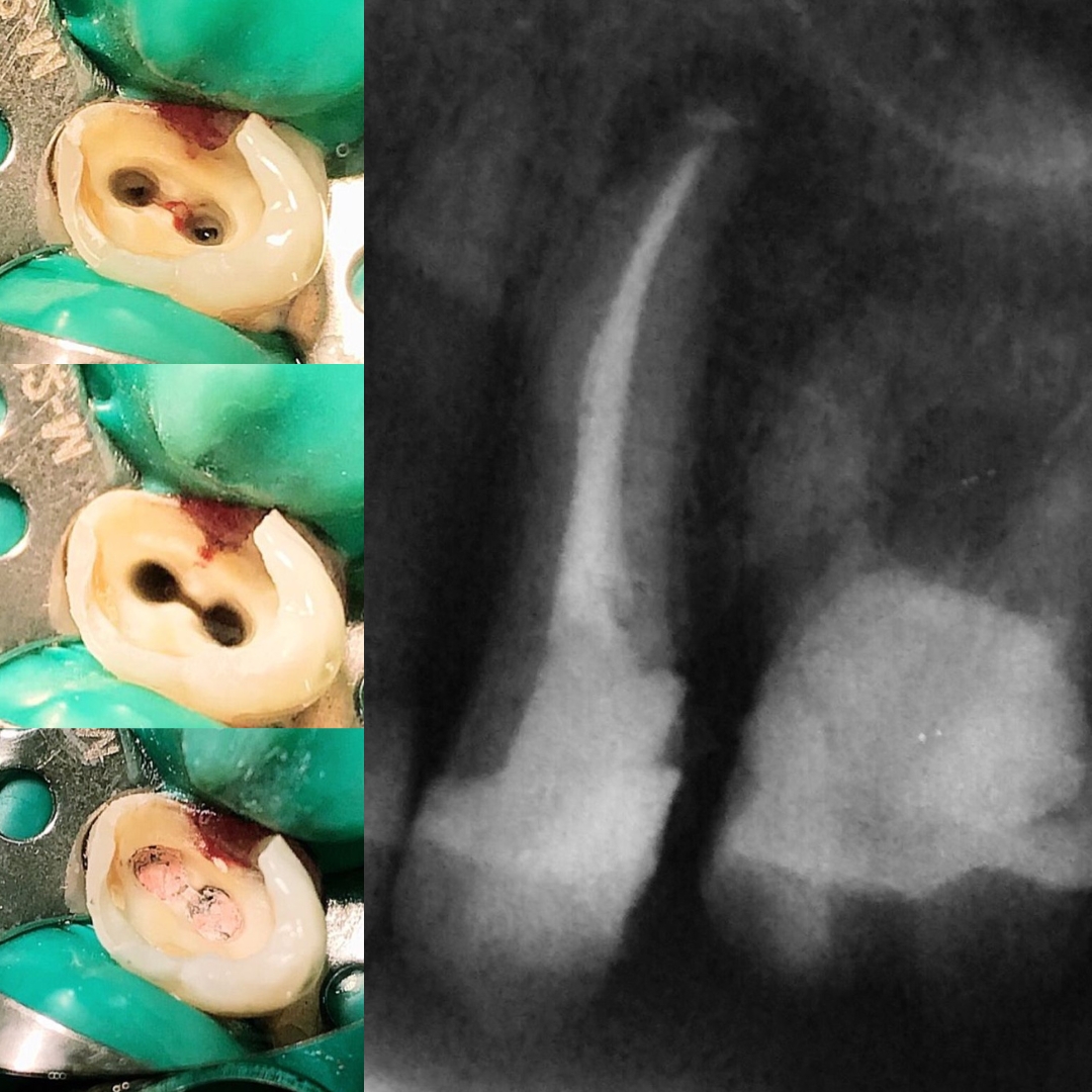 Rodrigues Odontologia Especializada Endodontia (Canal) #3.E