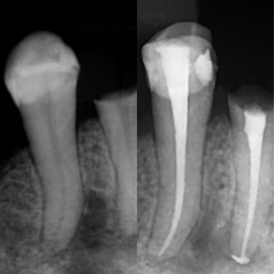 Rodrigues Odontologia Especializada Endodontia (Canal) #5.E