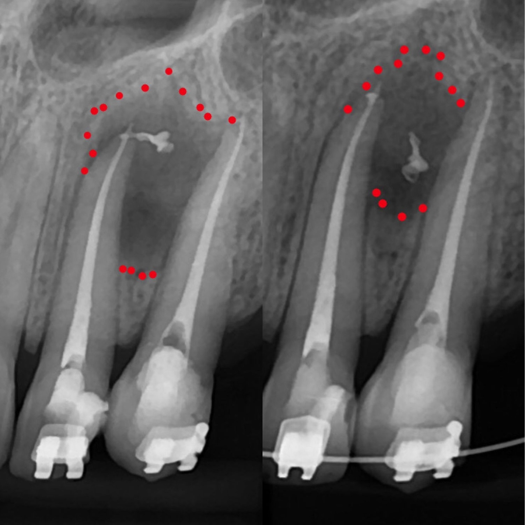 Rodrigues Odontologia Especializada Endodontia (Canal) #6.E
