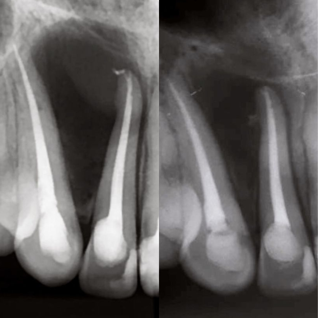 Rodrigues Odontologia Especializada Endodontia (Canal) #7.E