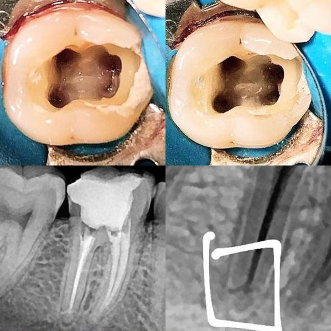 Rodrigues Odontologia Especializada Endodontia (Canal) #8.E