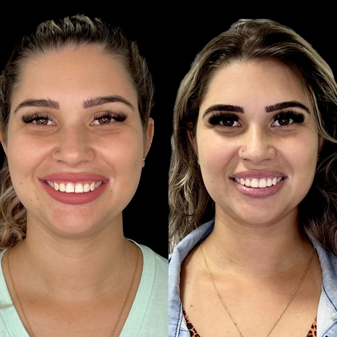Rodrigues Odontologia Especializada Facetas em Resina #2.E